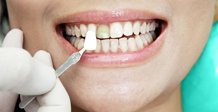 Costo delle Faccette Dentali e a Cosa Servono - Gremi Clinic