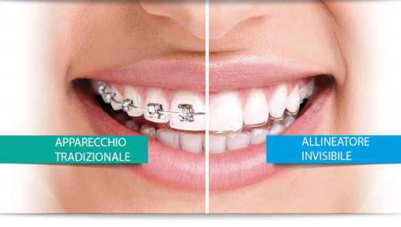 Come Avere Denti Perfetti “Senza Apparecchio”