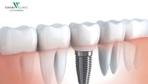 Impianti dentali dalla A alla Z: ecco tutto ciò che devi assolutamente sapere