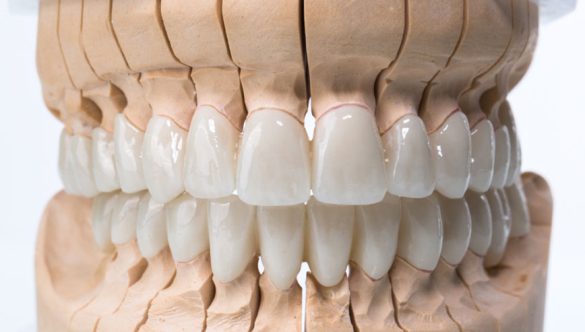 Prothèse dentaire fixe sur dents naturelles