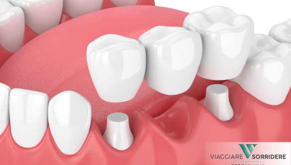 Cosa dovresti sapere su corone e ponti dentali