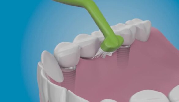 Come prenderti cura degli impianti dentali