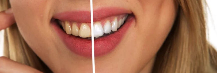 Cura delle gengive: importanza per la salute dentaria e per l’estetica del sorriso