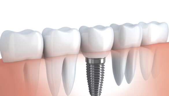 Comment obtenir le maximum de vos implants dentaires