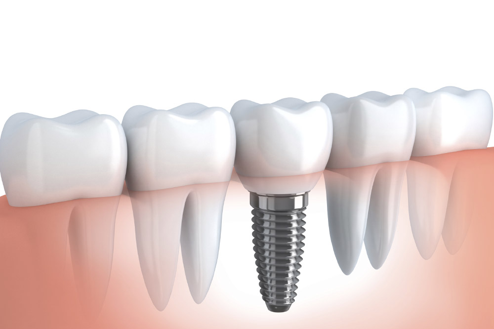 Comment obtenir le maximum de vos implants dentaires