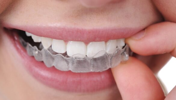 15 Domande sull’Ortodonzia Invisalign