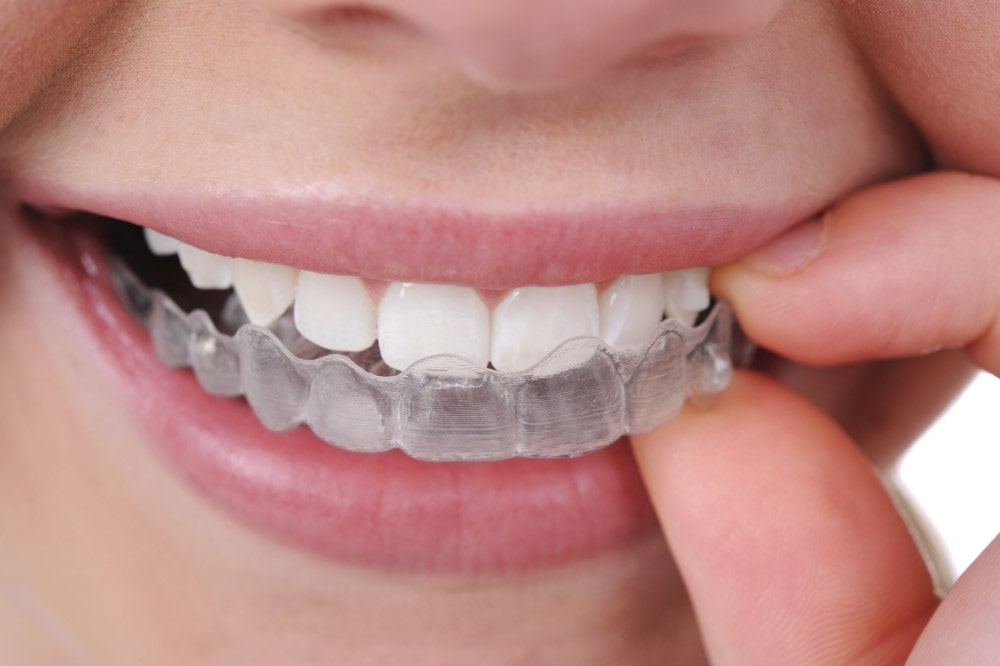 Comment nettoyer ses gouttières dentaires Invisalign ? - Dr Kamioner