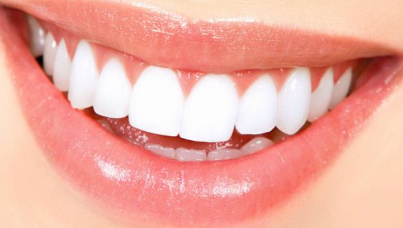 Sbiancamento dei Denti: In Cosa Consiste?