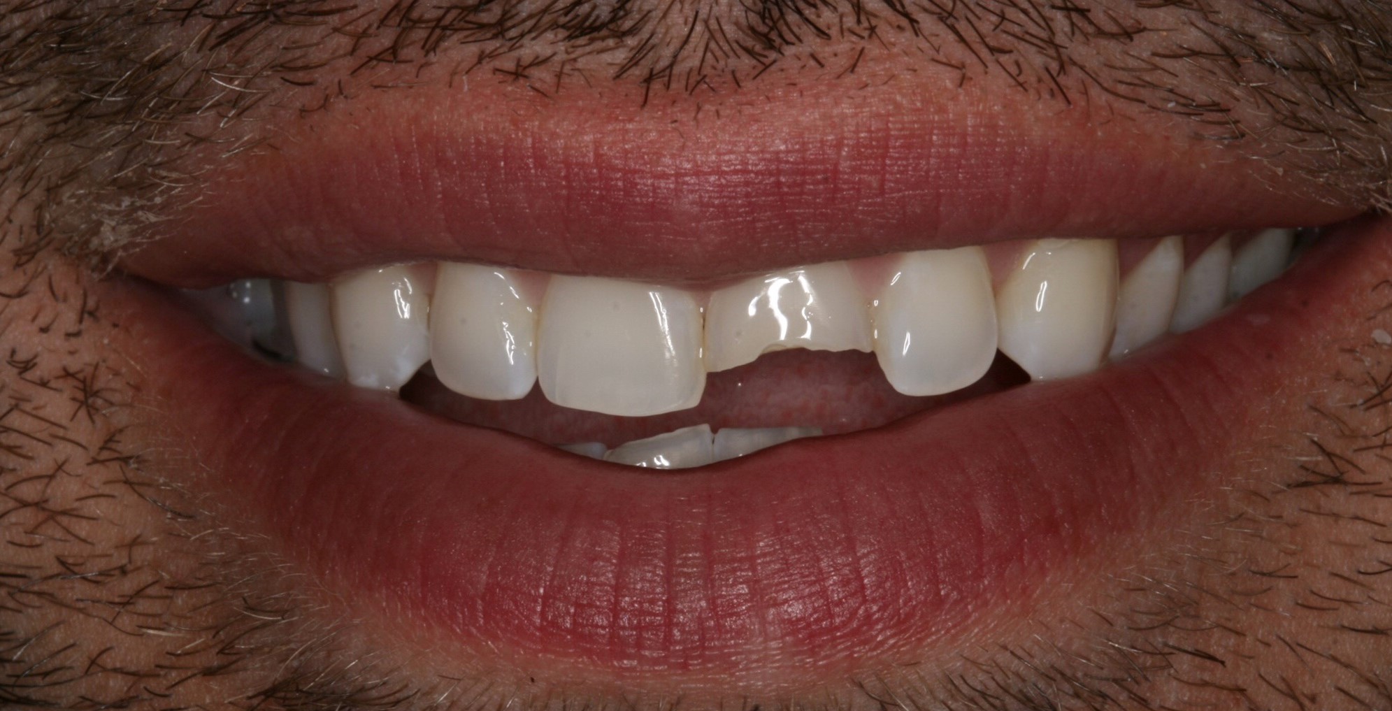 Porcelain-Crowns-Before