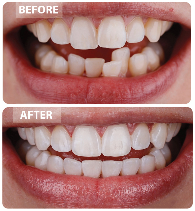 Invisalign-before-after2